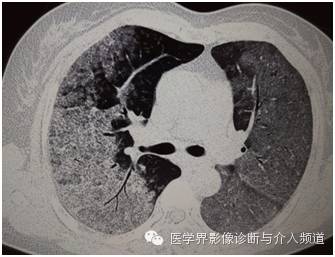 【病例】弥漫性肺腺癌1例CT影像表现 【病例】弥漫性肺腺癌1例CT影像表现