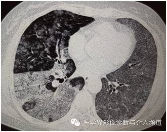 【病例】弥漫性肺腺癌1例CT影像表现 【病例】弥漫性肺腺癌1例CT影像表现