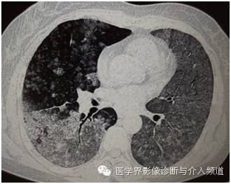 【病例】弥漫性肺腺癌1例CT影像表现 【病例】弥漫性肺腺癌1例CT影像表现