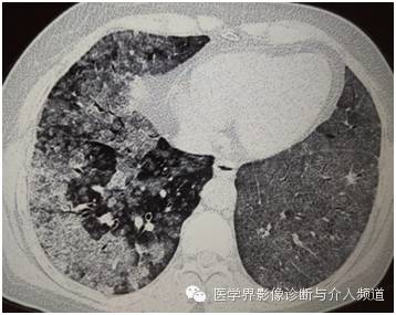 【病例】弥漫性肺腺癌1例CT影像表现 【病例】弥漫性肺腺癌1例CT影像表现