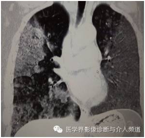 【病例】弥漫性肺腺癌1例CT影像表现 【病例】弥漫性肺腺癌1例CT影像表现