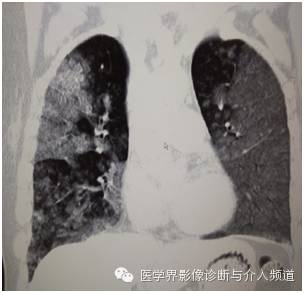 【病例】弥漫性肺腺癌1例CT影像表现 【病例】弥漫性肺腺癌1例CT影像表现