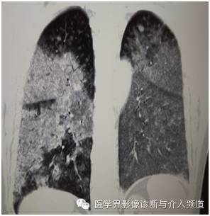 【病例】弥漫性肺腺癌1例CT影像表现 【病例】弥漫性肺腺癌1例CT影像表现