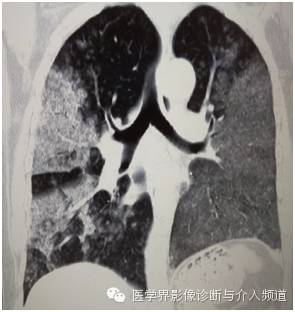 【病例】弥漫性肺腺癌1例CT影像表现 【病例】弥漫性肺腺癌1例CT影像表现