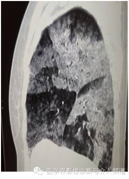 【病例】弥漫性肺腺癌1例CT影像表现 【病例】弥漫性肺腺癌1例CT影像表现