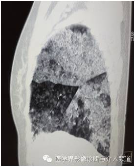 【病例】弥漫性肺腺癌1例CT影像表现 【病例】弥漫性肺腺癌1例CT影像表现