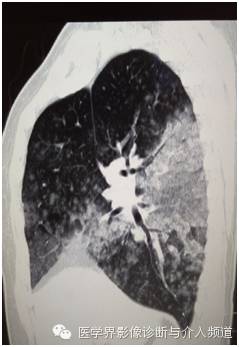 【病例】弥漫性肺腺癌1例CT影像表现 【病例】弥漫性肺腺癌1例CT影像表现