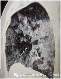 【病例】弥漫性肺腺癌1例CT影像表现 【病例】弥漫性肺腺癌1例CT影像表现