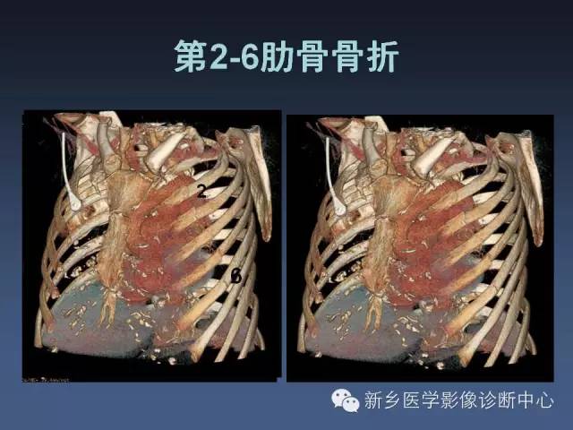 【PPT】多层螺旋CT（MDCT）在胸部外伤诊断中的应用