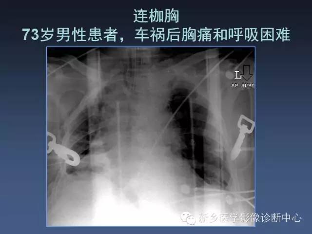 【PPT】多层螺旋CT（MDCT）在胸部外伤诊断中的应用