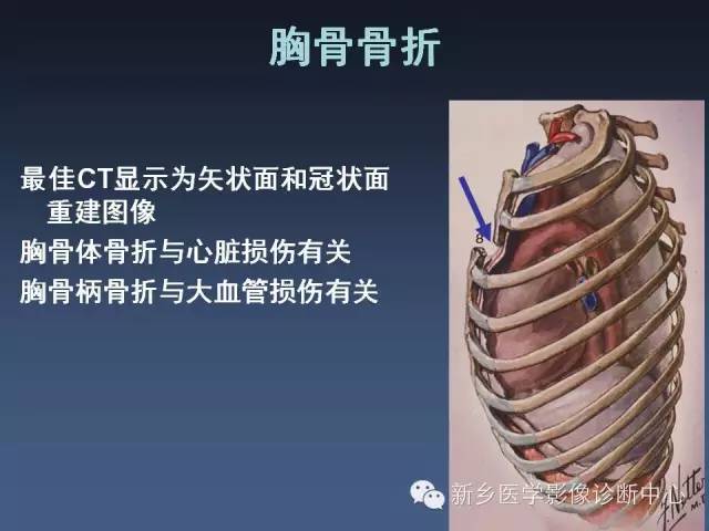 【PPT】多层螺旋CT（MDCT）在胸部外伤诊断中的应用
