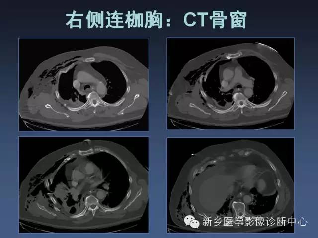 【PPT】多层螺旋CT（MDCT）在胸部外伤诊断中的应用