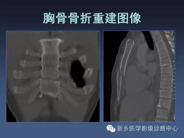 【PPT】多层螺旋CT（MDCT）在胸部外伤诊断中的应用
