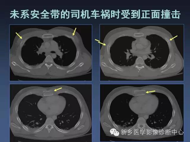 【PPT】多层螺旋CT（MDCT）在胸部外伤诊断中的应用