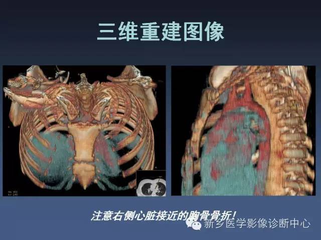 【PPT】多层螺旋CT（MDCT）在胸部外伤诊断中的应用