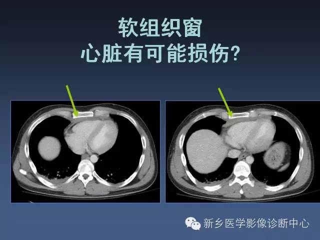 【PPT】多层螺旋CT（MDCT）在胸部外伤诊断中的应用