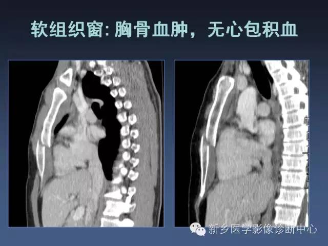 【PPT】多层螺旋CT（MDCT）在胸部外伤诊断中的应用