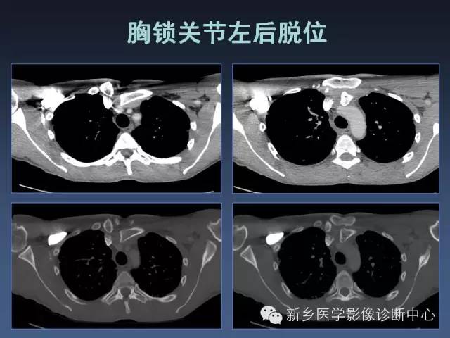 【PPT】多层螺旋CT（MDCT）在胸部外伤诊断中的应用