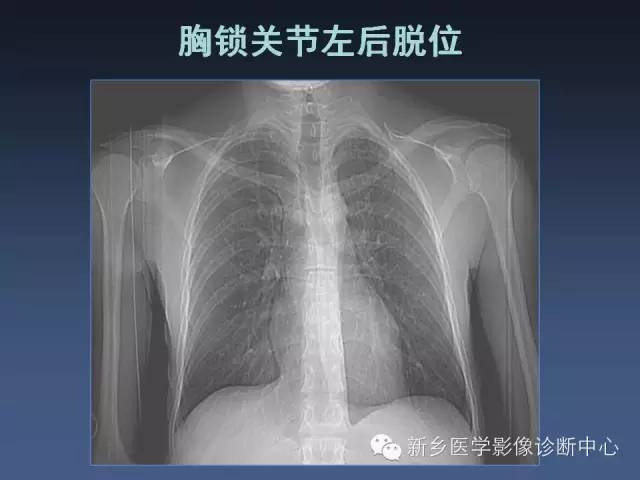【PPT】多层螺旋CT（MDCT）在胸部外伤诊断中的应用