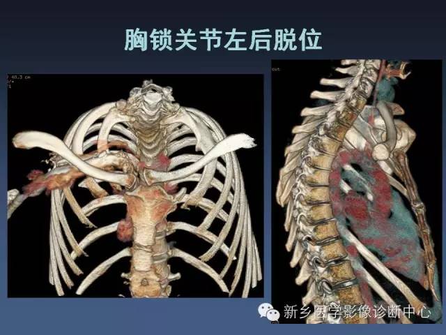 【PPT】多层螺旋CT（MDCT）在胸部外伤诊断中的应用