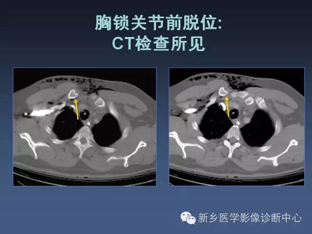 【PPT】多层螺旋CT（MDCT）在胸部外伤诊断中的应用