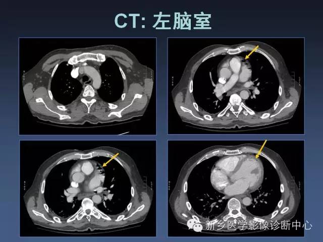【PPT】多层螺旋CT（MDCT）在胸部外伤诊断中的应用