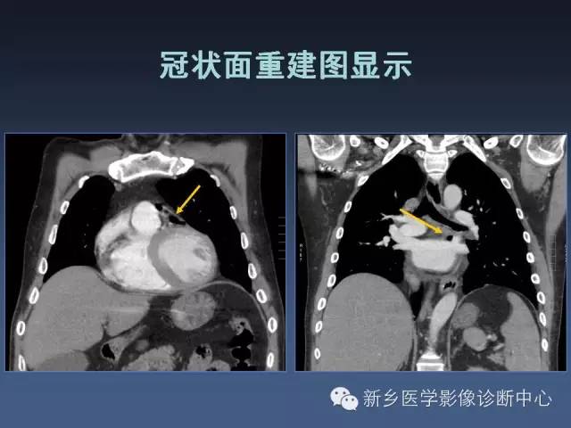 【PPT】多层螺旋CT（MDCT）在胸部外伤诊断中的应用