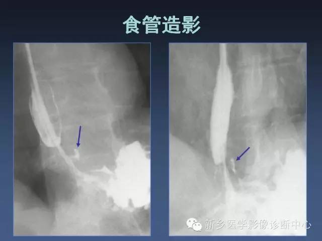 【PPT】多层螺旋CT（MDCT）在胸部外伤诊断中的应用