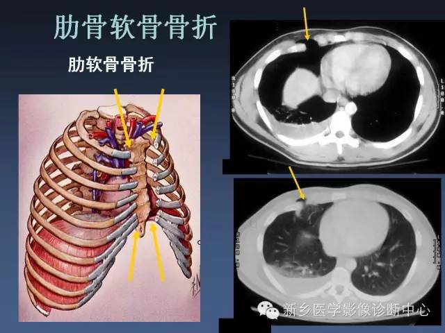 【PPT】多层螺旋CT（MDCT）在胸部外伤诊断中的应用
