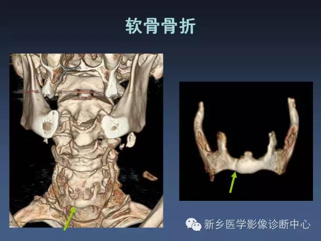 【PPT】多层螺旋CT（MDCT）在胸部外伤诊断中的应用