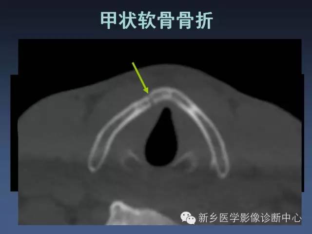 【PPT】多层螺旋CT（MDCT）在胸部外伤诊断中的应用