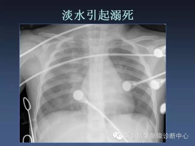 【PPT】多层螺旋CT（MDCT）在胸部外伤诊断中的应用