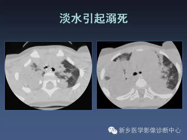 【PPT】多层螺旋CT（MDCT）在胸部外伤诊断中的应用