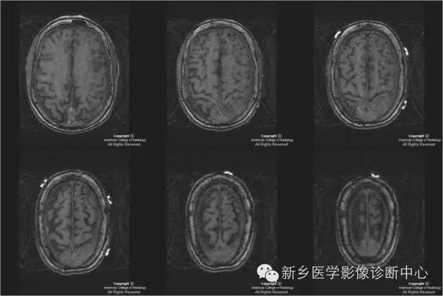 【病例】硬脑膜浆细胞瘤1例MR影像表现
