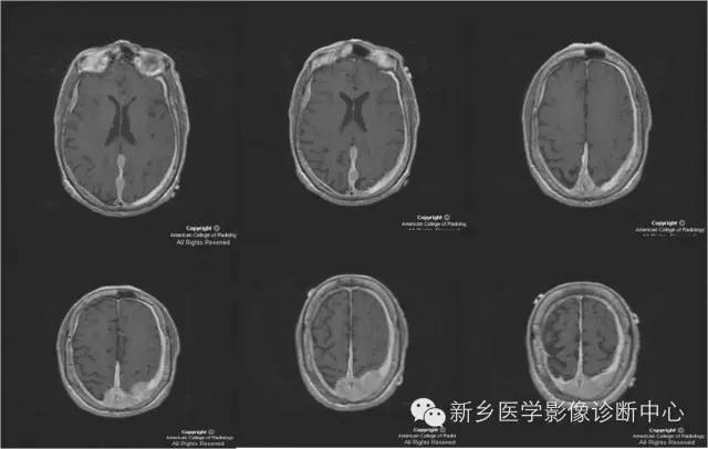【病例】硬脑膜浆细胞瘤1例MR影像表现