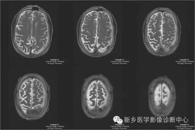 【病例】硬脑膜浆细胞瘤1例MR影像表现