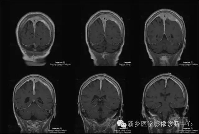 【病例】硬脑膜浆细胞瘤1例MR影像表现