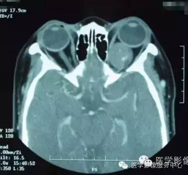 【病例】眼眶海绵状血管瘤1例CT MR影像表现