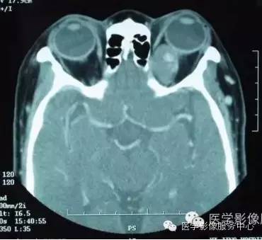 【病例】眼眶海绵状血管瘤1例CT MR影像表现 【病例】眼眶海绵状血管瘤1例CT MR影像表现