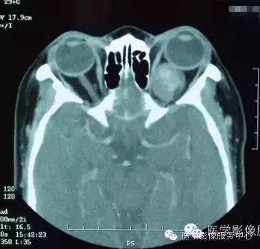 【病例】眼眶海绵状血管瘤1例CT MR影像表现 【病例】眼眶海绵状血管瘤1例CT MR影像表现