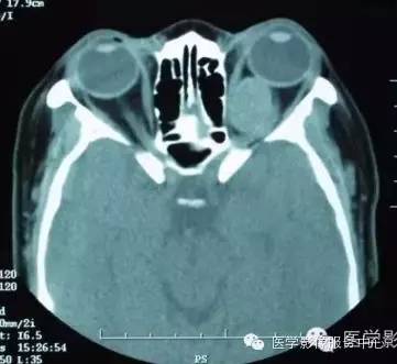 【病例】眼眶海绵状血管瘤1例CT MR影像表现 【病例】眼眶海绵状血管瘤1例CT MR影像表现