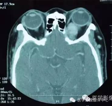 【病例】眼眶海绵状血管瘤1例CT MR影像表现 【病例】眼眶海绵状血管瘤1例CT MR影像表现