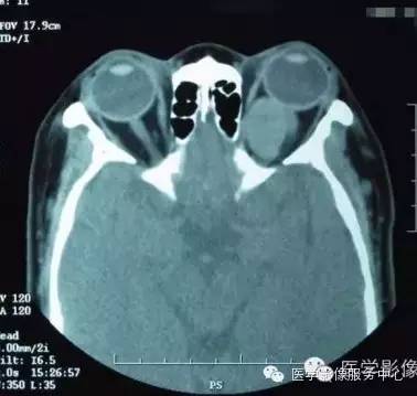 【病例】眼眶海绵状血管瘤1例CT MR影像表现 【病例】眼眶海绵状血管瘤1例CT MR影像表现