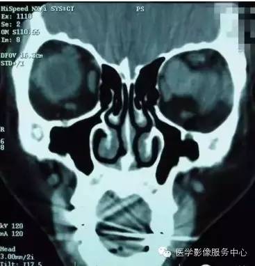 【病例】眼眶海绵状血管瘤1例CT MR影像表现 【病例】眼眶海绵状血管瘤1例CT MR影像表现