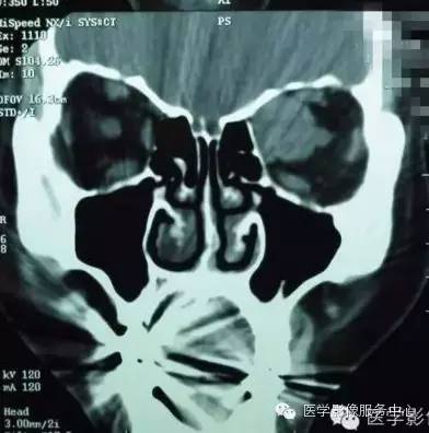 【病例】眼眶海绵状血管瘤1例CT MR影像表现 【病例】眼眶海绵状血管瘤1例CT MR影像表现