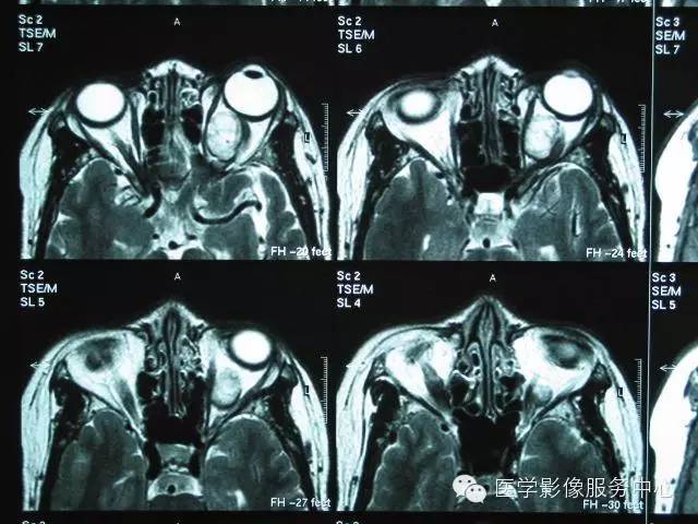 【病例】眼眶海绵状血管瘤1例CT MR影像表现 【病例】眼眶海绵状血管瘤1例CT MR影像表现