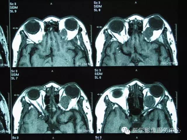 【病例】眼眶海绵状血管瘤1例CT MR影像表现 【病例】眼眶海绵状血管瘤1例CT MR影像表现