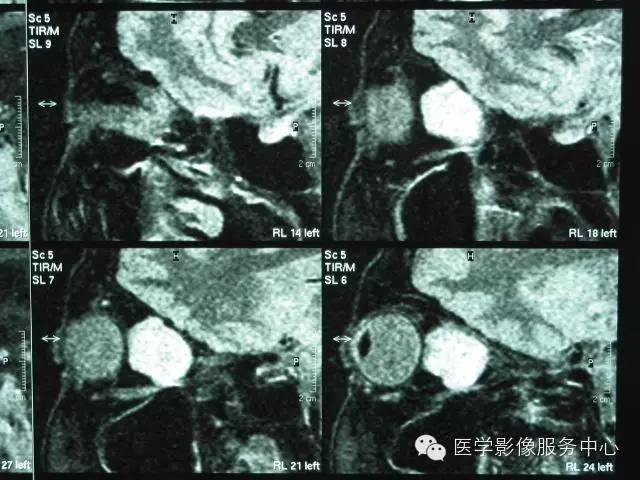 【病例】眼眶海绵状血管瘤1例CT MR影像表现 【病例】眼眶海绵状血管瘤1例CT MR影像表现
