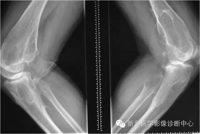 【病例】多发骨软骨瘤1例X线影像表现
