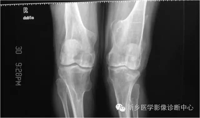 【病例】多发骨软骨瘤1例X线影像表现 【病例】多发骨软骨瘤1例X线影像表现